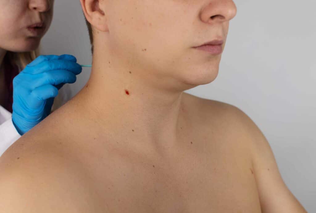 Close-up of the wound that remained after excision of the nevus. Removal and treatment of benign skin lesions. Surgery. Doctor and patient in one shot. Skin disease treatment and surgical care concept | San Carlos IV Bar in California