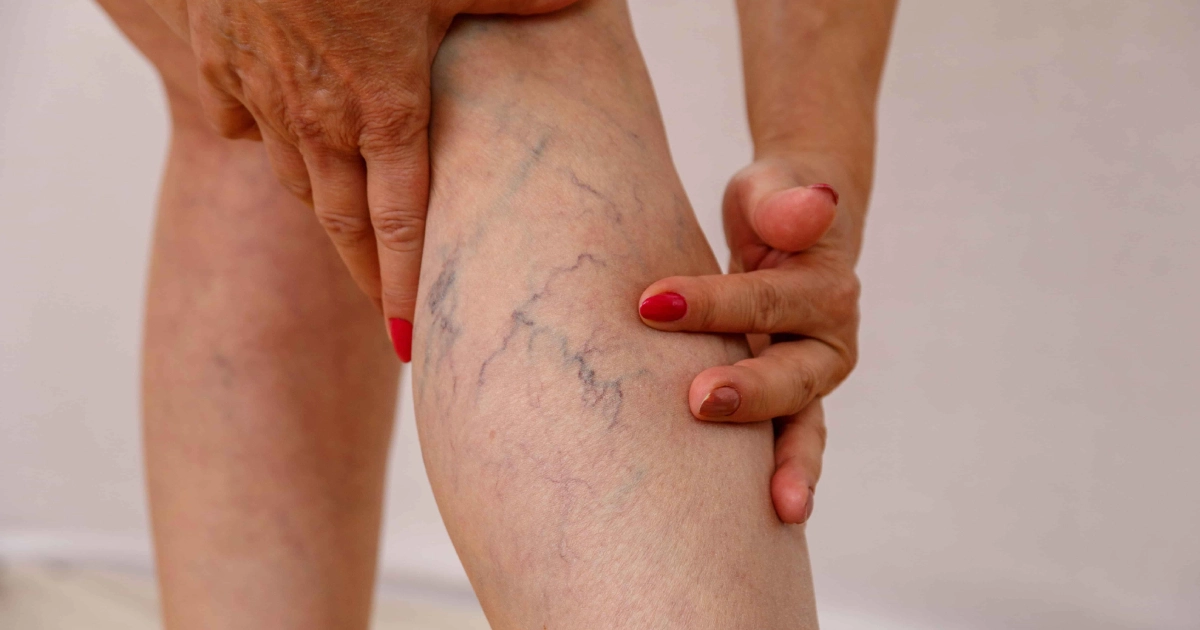 Close-up of a person's leg, showing noticeable spider veins on the calf before Vein Treatments in San Carlos, CA