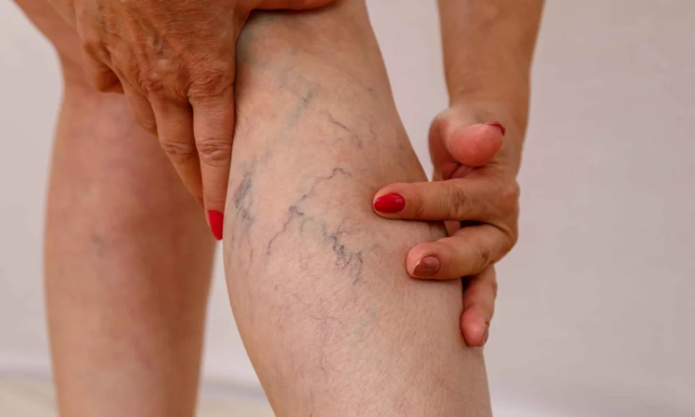 Close-up of a person's leg, showing noticeable spider veins on the calf before Vein Treatments in San Carlos, CA