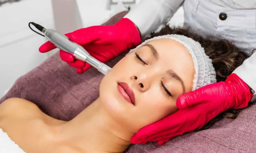 Microneedling-sancarlosivbar